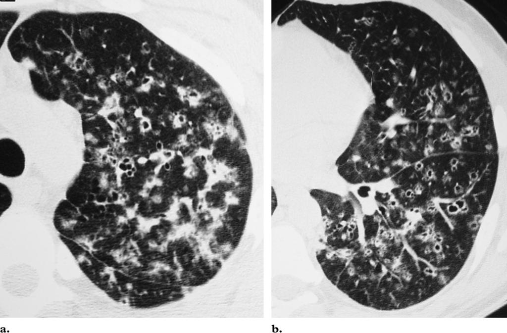 RG f Volume 24 Number 3 Abbott et al 835 Figure 15. PLCH in a 30-year-old man with a history of cigarette smoking, recent fatigue, and malaise.