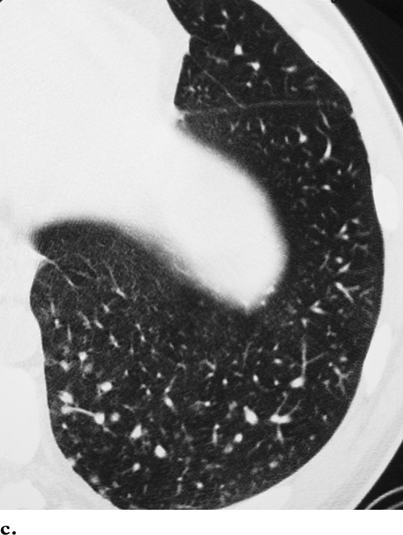Highresolution CT scans (lung window) show irregular nodules and thick- (a) and thin-walled (b) cysts with relative sparing of the lung bases (c).