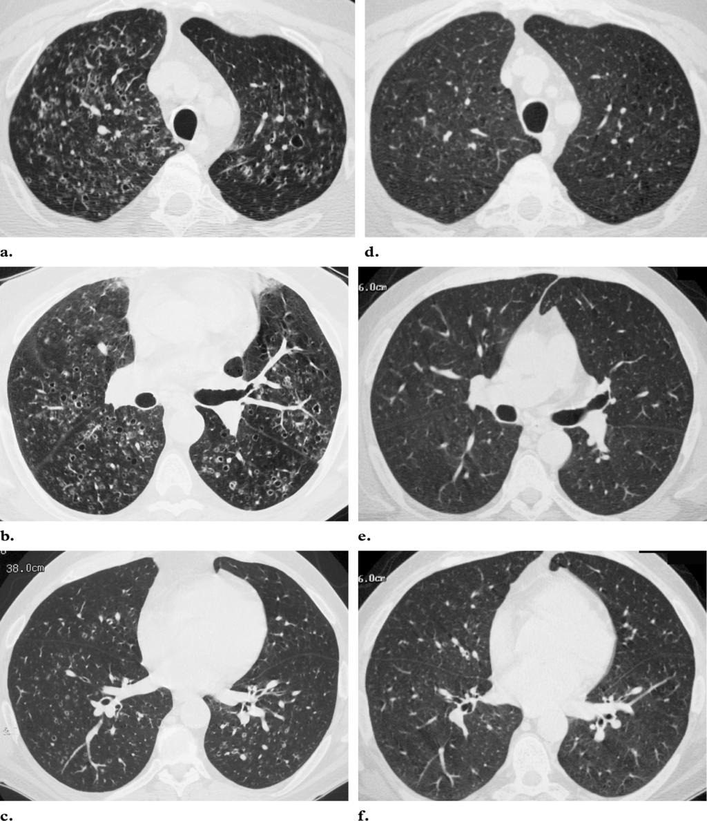 838 May-June 2004 RG f Volume 24 Number 3 Figure 18. PLCH in a 52-year-old physician with a long history of cigarette smoking and worsening cough.