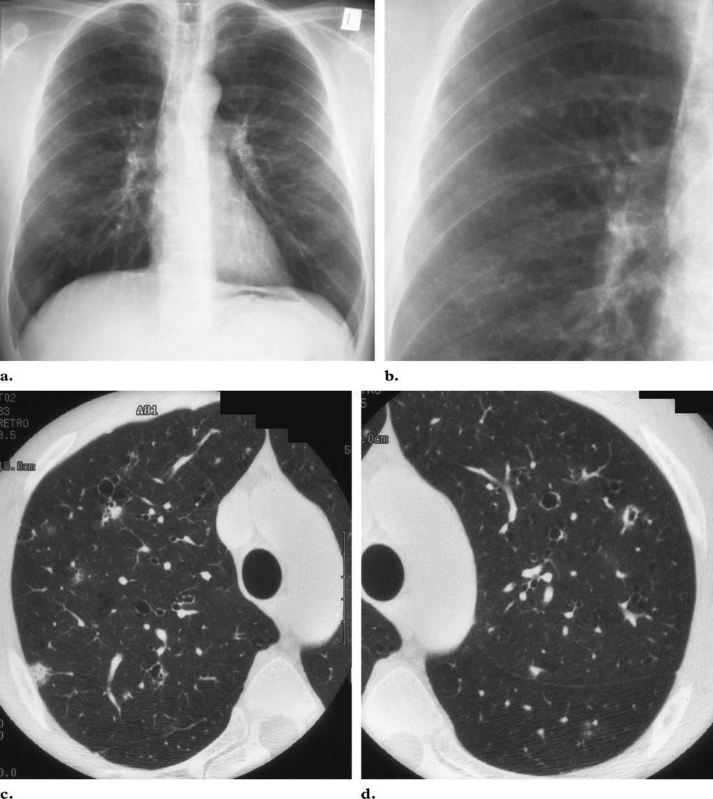 RG f Volume 24 Number 3 Abbott et al 829 Figure 7. PLCH in a 41-year-old man with fatigue, malaise, weight loss, and a 50-pack year history of cigarette smoking.