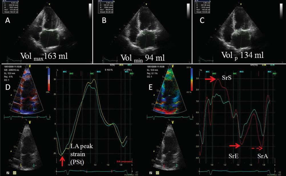 Left atrial function and remodelling 301 Figure 1 Examples of measurement of left atrial volumes and tissue Doppler strain imaging in a four-chamber view in a patient with aortic stenosis.