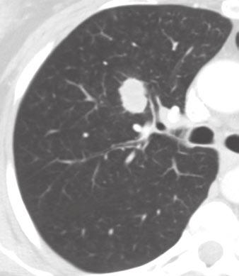 Of 67,725 cases of NSCLC initially included in the ISLC database, 18,198 cases met the inclusion criteria for T designation analysis by having accurate clinical or pathologic staging and no