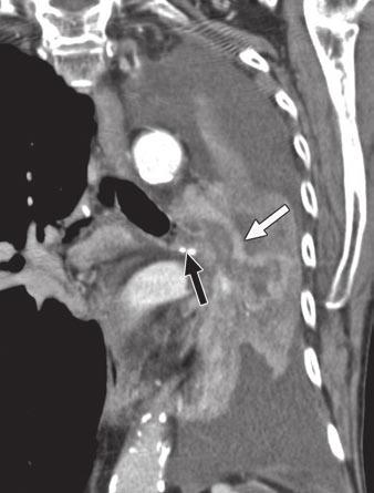 5 cm left hilar mass (white arrow), which is difficult to differentiate from surrounding atelectatic lung. Mass extends into mainstem bronchus (black arrow) 1.