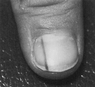 Figure 10. Junctional nevus of the nail in a child. darkens, or otherwise alters the nail plate needs further evaluation.