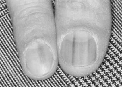 When there is doubt about the diagnosis, referral to a dermatologist and biopsy of nail bed, nail matrix, or surrounding tissue are indicated.