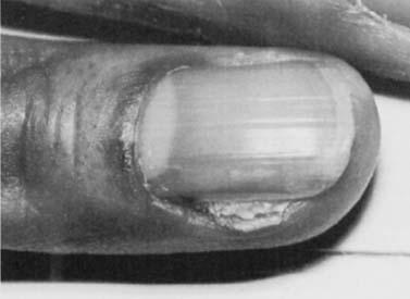 NAIL DISORDERS 1181 Figure 12. Squamous cell carcinoma of the nail. Both basal cell carcinoma and squamous cell carcinoma (Fig. 12) occur rarely in the nail bed.