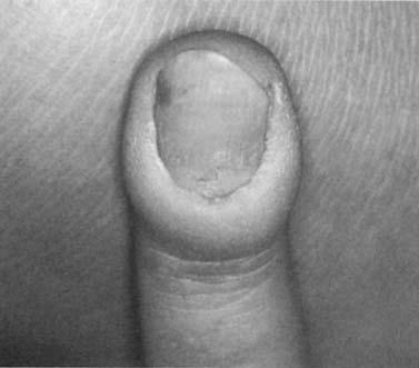 NAIL DISORDERS 1175 Figure 5. Chronic paronychia. discoloration on the surface of the toenail that can be easily scraped away with a blade.