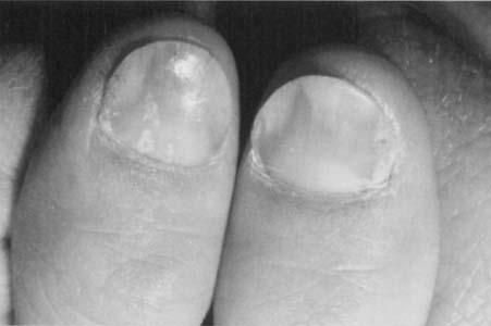 1178 RICH Figure 7. Psoriasis of the fingernails showing pitting, onycholysis, splinter hemorrhages, and oil drop discoloration. are usually disappointing in severe psoriatic involvement of the nails.