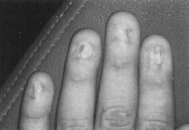 NAIL DISORDERS 1179 Figure 9. End stage lichen planus of the nails with total destruction of the nail unit. grow (Fig 9).