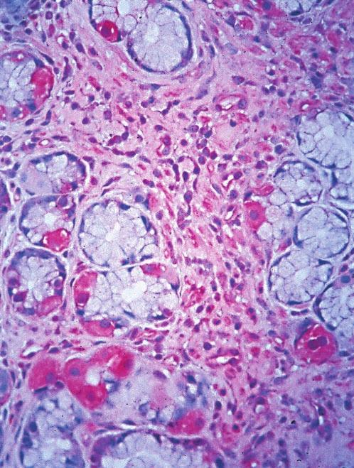 (B) Medium-power photomicrograph showing a spotty distribution of COX-2 positive gastric surface cells from a patient with treated H. pylori gastritis (original magnification 235).