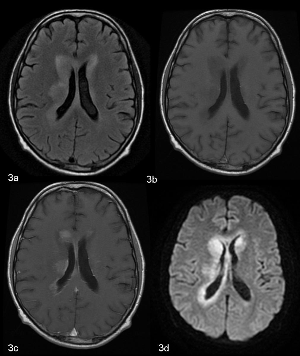 Fig. 8: CNS lymphoma. 3a: Axial FLAIR image demonstrates irregular rim of periventricular white matter FLAIR hyperintensity involving the corpus callosum.