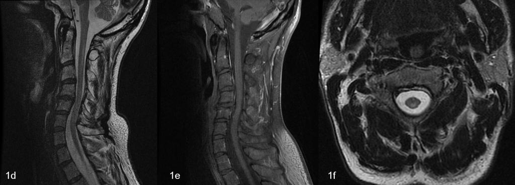 This is the most common spinal cord manifestation of HIV infection. Patients may present with insidious onset of ataxia, urinary dysfunction and sensory loss.