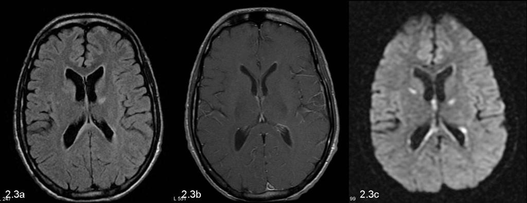 Fig. 5: Cytomegalovirus infection (CMV). 2.3a: Axial FLAIR image demonstrates mildly enlarged ventricles with surrounding T2 hyperintensity. 2.3b: Axial post contrast image demonstrates ependymal and periventricular enhancement, in keeping with ventriculitis.