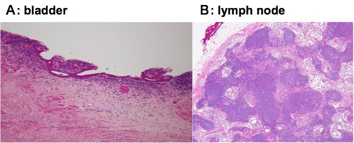 Figure 3: Microscopically, no malignant cells were observed in the bladder (A) nor the regional lymph nodes (B). ml/min and, therefore, cisplatin was replaced by oxaliplatin.