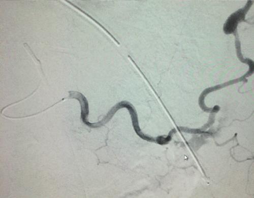 CASE 2 A patient with a history of Osler-Weber-Rendu syndrome underwent previous coil embolization of a left lower lobe pulmonary AVM 5 years before