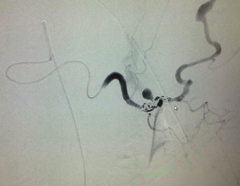 An MVP plug was placed at the origin of the pulmonary artery branch supplying the AVM, and angiography was performed via the microcatheter (B) before