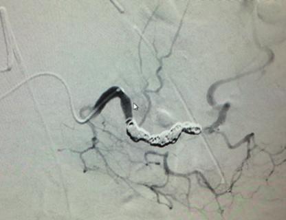 The final angiogram (C) showed complete occlusion of the AVM with a single device and preservation of flow to the adjacent pulmonary artery branches.