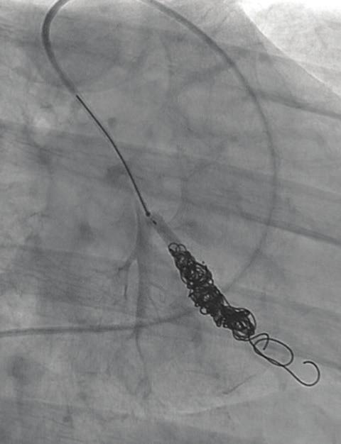 After a proximal 5-mm MVP plug (arrow) was deployed, the pseudoaneurysm was isolated with no further contrast extravasation but with preserved collateral flow