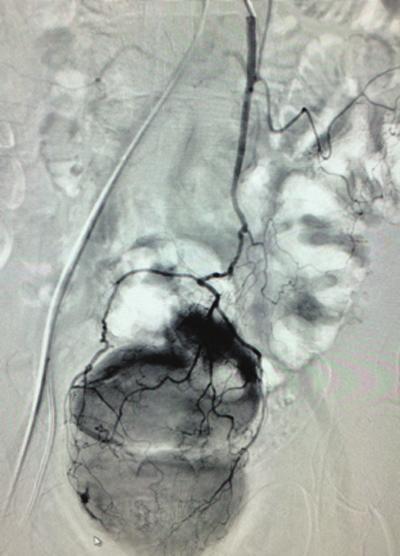 CASE 5 A B C D A patient presented with recurrent rectal hemorrhage with hypotension. An inferior mesenteric arteriogram showed active contrast extravasation (A).