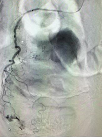 Lumbar artery pseudoaneurysm after cryoablation (Case 4). Lower gastrointestinal hemorrhage (Case 5). Another potential application of the MVP plug would be temporary vessel occlusion.