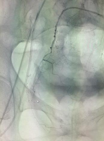 In such a case, an interventionist may place an MVP plug in the GDA (leaving it on the delivery catheter undeployed) while performing radioembolization via a second access microcatheter.