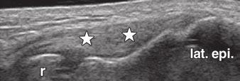 In healthy volunteers, no symptomatic common extensor tendon origin was detected. The overall ultrasound and real-time sonoelastographic findings are shown in Table 1.