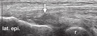 De Zordo et al. between tendon and fascial structures in healthy volunteers, but involvement of the common tendon and fascia was found in patients (11 of 38 elbows with symptomatic abnormalities).