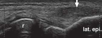 Longitudinal ultrasound scan (C) shows no alteration in radial collateral ligament (arrow), but real-time sonoelastographic image (D) shows ligament (arrow) is soft.