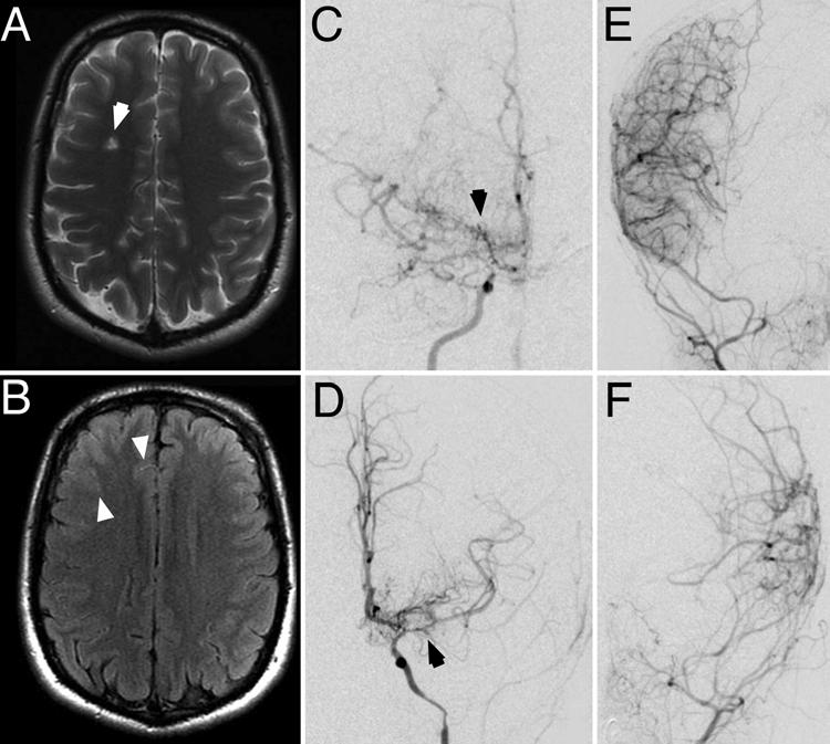 Moyamoya patients under 2 years of age Fig. 1. Illustrative case involving an 18-month-old boy with bilateral moyamoya treated with bilateral pial synangiosis.