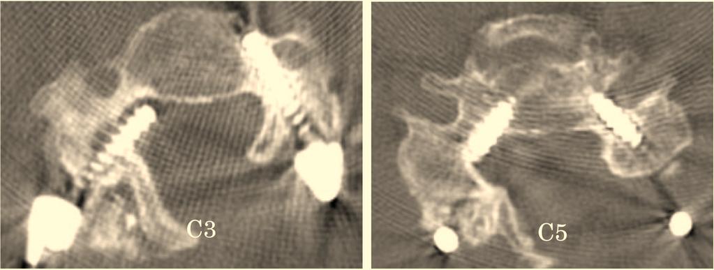 Perforation Rates of Cervical Pedicle Screw Insertion The Open Orthopaedics Journal, 2010, Volume 4 145 Fig. (2). 71 year-old female with cervical spondylotic myelopathy.