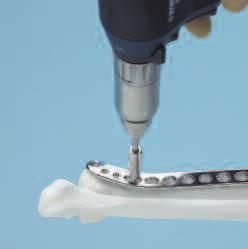 This instrument can be used for: Minor varus-valgus adjustment Translational adjustments Provisional fixation Stabilization of plate-bone orientation during insertion of the first screws Alignment of