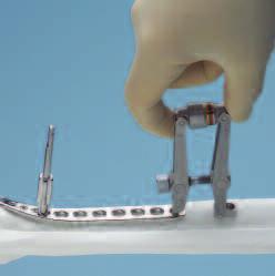 screw length. 7 Option: articulated tension device Instrument 321.