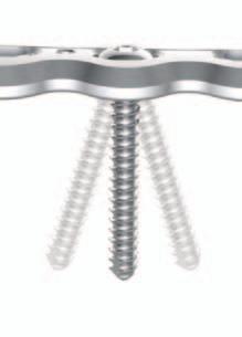 5mm Standard Cortical Screws can be placed in Neutral, Compression or Buttress positions as desired using the relevant Drill Guides and the standard technique.