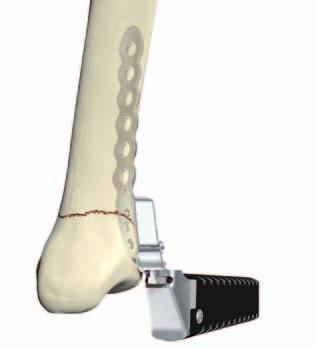 This step shows the position of the screw in relation to the joint surface and confirms the screw will not be intra articular.