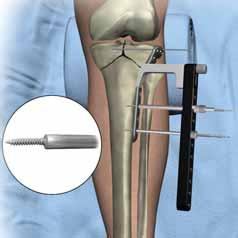 9 To achieve varus-valgus correction, advance the nut towards the sheath and monitoring progress under fluoroscopy, continue tightening the anchor bolt nut until the desired reduction is achieved