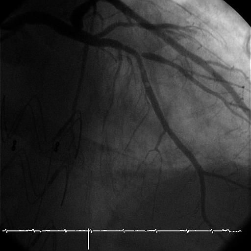 presented with VF (stent thrombosis).