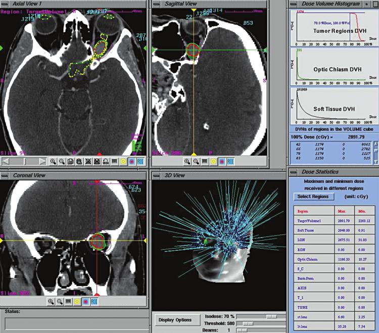 P. Romanelli, B. Wowra, and A. Muacevic FIG. 3. CyberKnife treatment planning screenshot of a left ONSM, showing axial, sagittal, and coronal images as well as the maximum dose (28.
