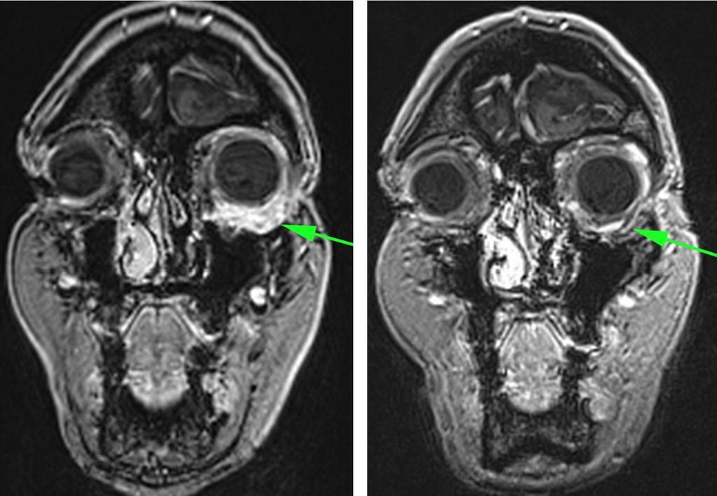 438 Klingenstein et al. Figure 2: CT-scan before (left) and after radiosurgery (right). Diminuation of the orbital metastasis (see arrow). large orbital metastases (21).