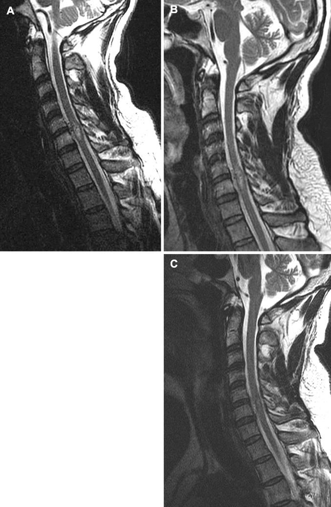 Spinal AVMs Eradication of Glomus (Type 2) AVM at C5-C6 Sinclair, John M.D.