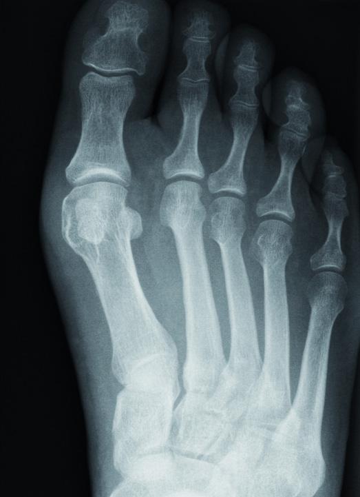 FIGURE 1 (a) The initial dorsoplantar radiograph of the left foot in a patient