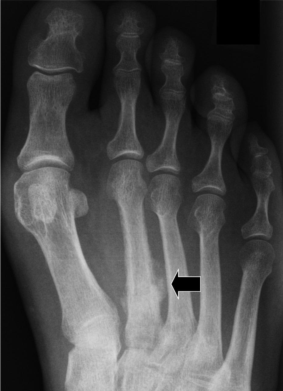 A follow-up dorsoplantar radiograph of the left foot in a patient with a stress