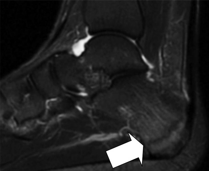 FIGURE 4 Sagittal fat-saturated T2-weighted image of the left ankle demonstrating