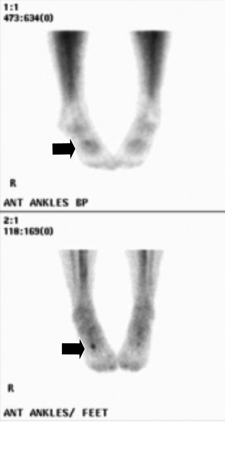 FIGURE 2 Two images from a Tc99m-MDP bone scan of the right foot demonstrating a stress fracture within the shaft