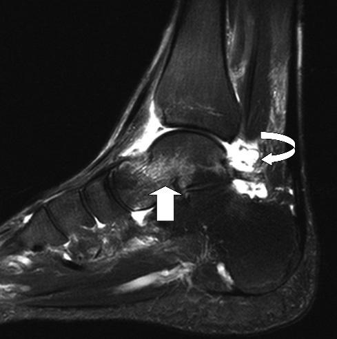 hypointense fracture line perpendicular to the trabeculae and parallel to the talonavicular joint (arrow).
