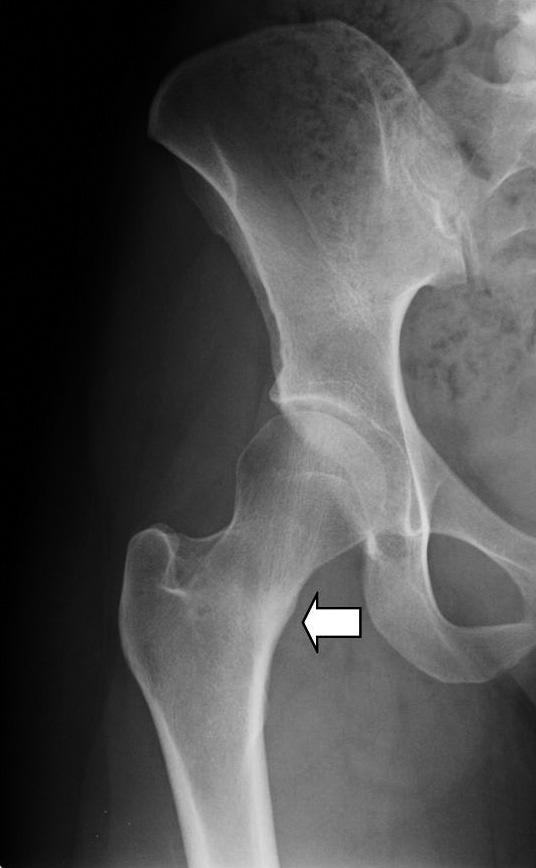 (c) FIGURE 5 (a) Anteroposterior plain film of the right hip demonstrating a proximal femoral