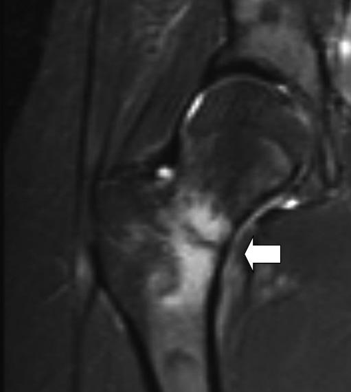 with a hypointense fracture line with surrounding bone oedema (arrow).