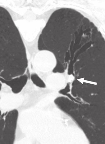 plane (), and volume-rendering reformation (C) in similar orientation. In C, arrow points to distal bronchiectasis.