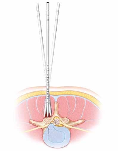 STEP 4 -Initial Dilation STEP 5 - Serial Dilation and Depth Gauging Once the incision is made, the First Dilator is inserted into the incision, bluntly piercing the fascia to dilate the paravertebral
