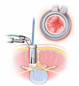 Caution: SPOTLIGHT Retraction Ports operate like other instruments with fiberoptics, such as endoscopes. Care should be taken when flashing these ports.