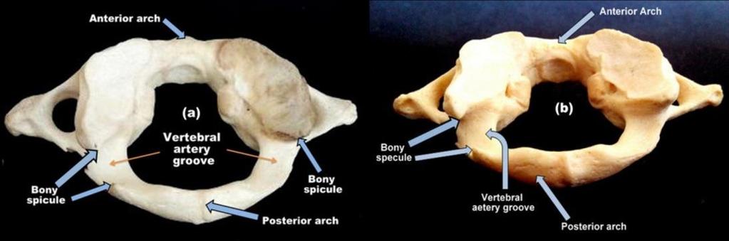 3 Unilateral complete lateral ponticle (Right Side) DISCUSSION The atlas vertebra shows the highest variability amongst all cervical vertebrae.